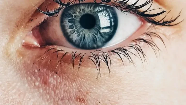 Melasma gestacional manchas en el embarazo