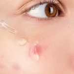 tratamiento del acne juvenil en Barcelona