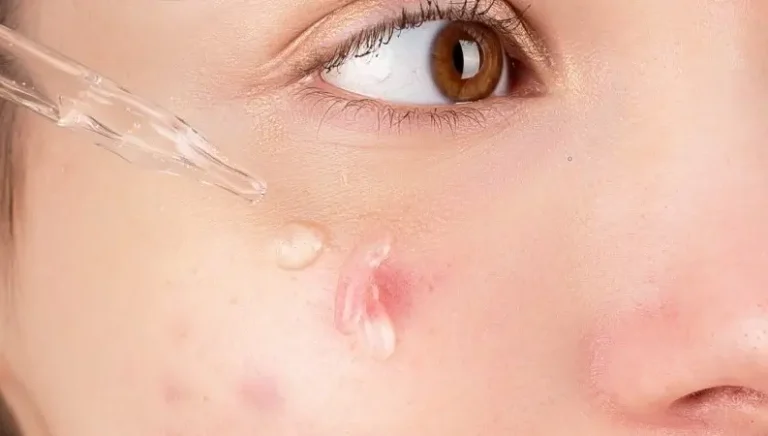 tratamiento del acne juvenil en Barcelona
