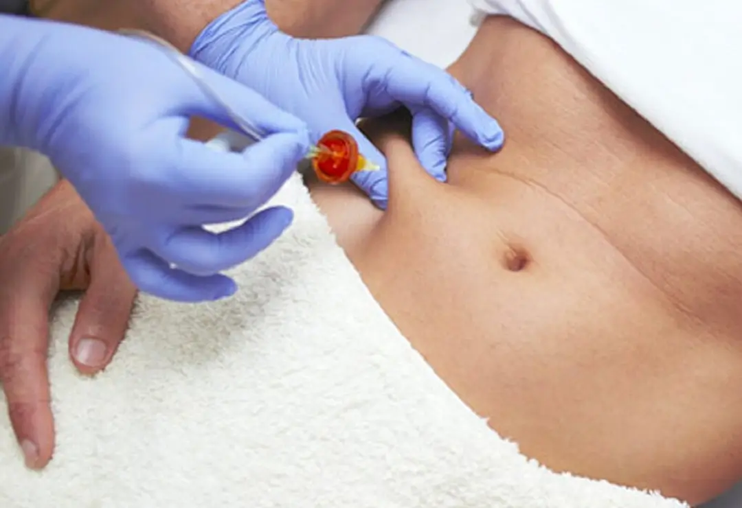 Carboxiterapia Corporal en Barcelona
