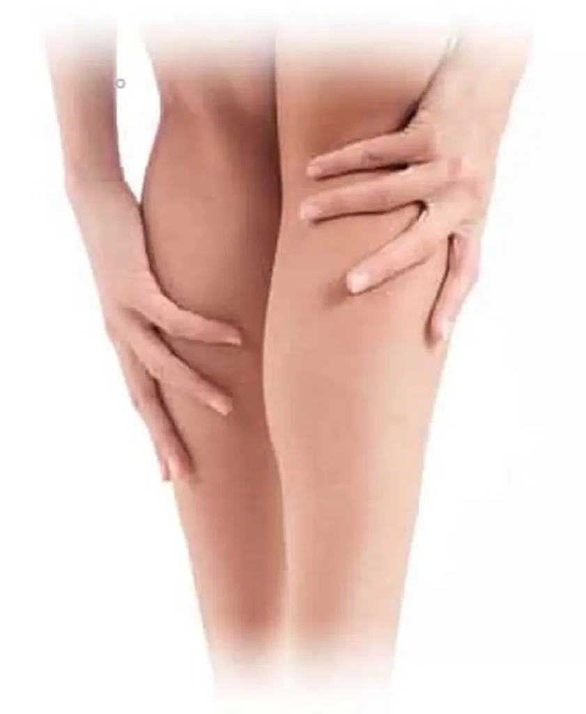 La escleroterapia o esclerosis de venas es un procedimiento ambulatorio para eliminar várices y arañas vasculares