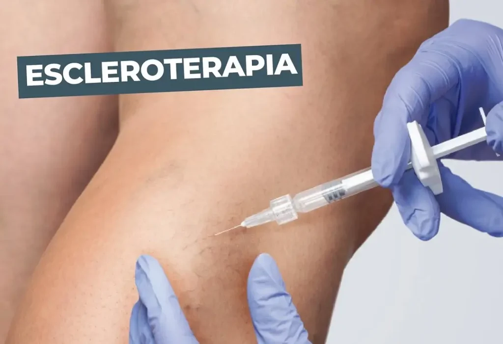 El esclerosado de venas sirve para tratar y eliminar las venas varicosas