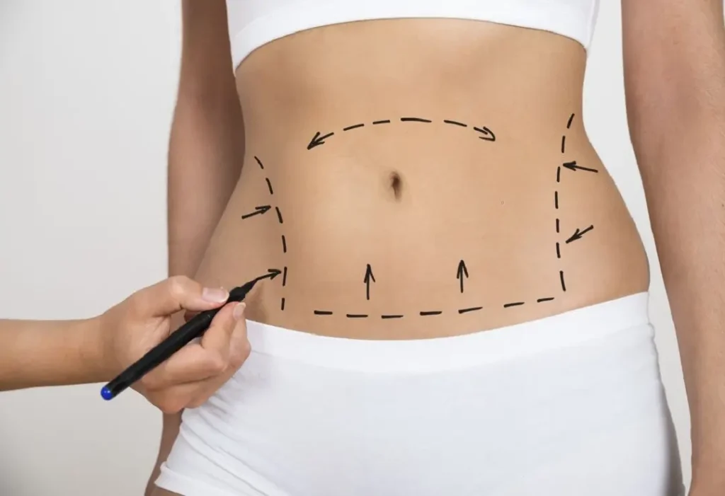 La abdominoplastia es una cirugía que está indicada para eleminar el exceso de grasa que hay a nivel abdominal