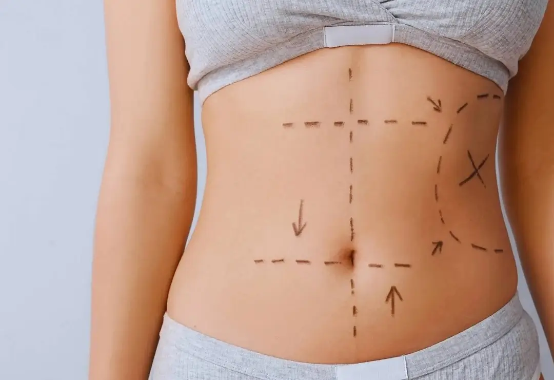 La lipoescultura o liposucción es el método más popular de cirugía de contorno corporal