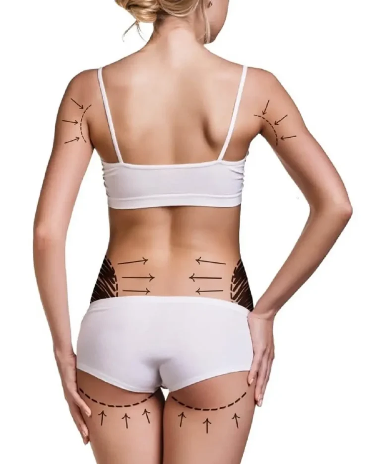 aspectos clave de la liposucción