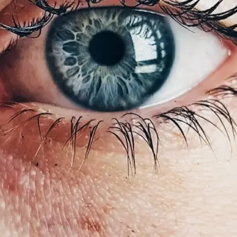 Melasma gestacional manchas en el embarazo