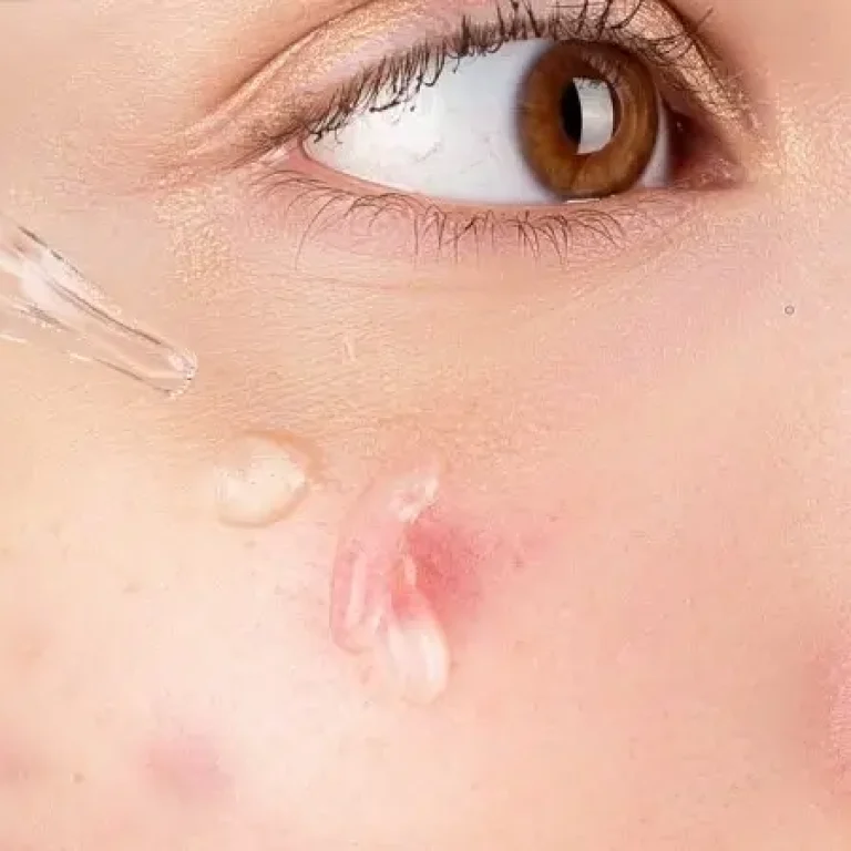 tratamiento del acne juvenil en Barcelona